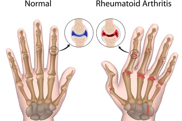 Rheumatoid Arthritis Vs. Lupus: How Do They Differ? Rheumatoid Arthritis Vs. Lupus: How Do They Differ?