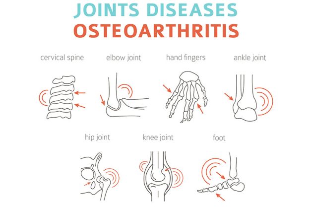 What Is Osteoarthritis? Learn The Different Stages