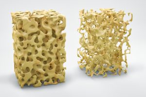 Can You Reverse Osteoporosis