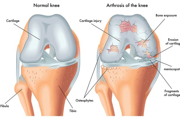 Osteoarthritis Vs. Rheumatoid Arthritis: How Do They Differ?