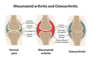 Osteoarthritis Vs. Rheumatoid Arthritis: 3 Differences