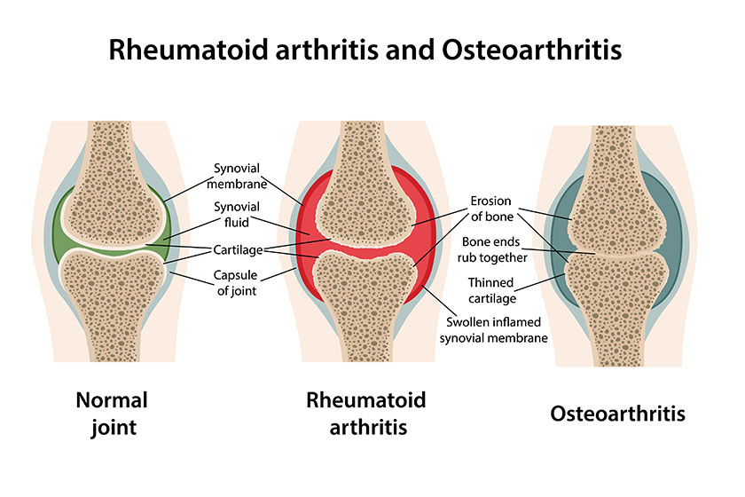 Osteoarthritis Vs Rheumatoid Arthritis 3 Differences Morada Senior Living