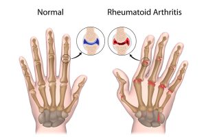 Rheumatoid arthritis of hand