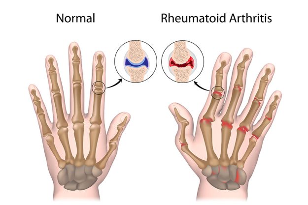 Rheumatoid arthritis of hand Rheumatoid arthritis of hand