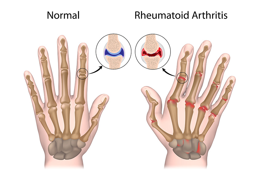 Rheumatoid arthritis of hand Morada Senior Living