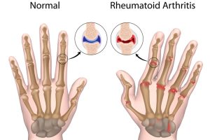 6 Types Of Arthritis: Which Is The Most Common?