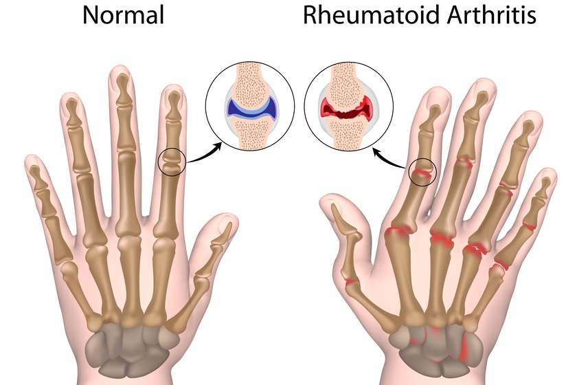 6 Types Of Arthritis Which Is The Most Common Img 