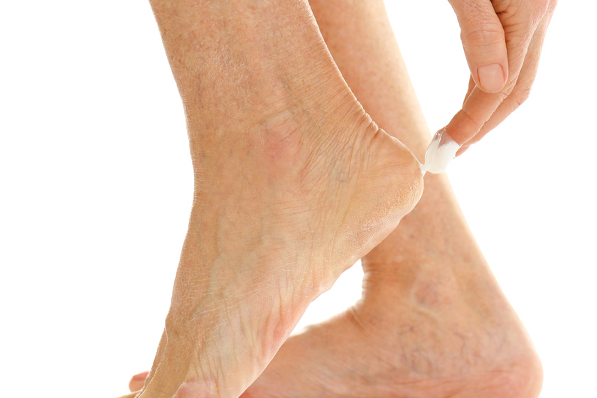 Female hand applying cosmetic cream on heel, closeup Foot Care Management In Senior Assisted Living In Euless, TX