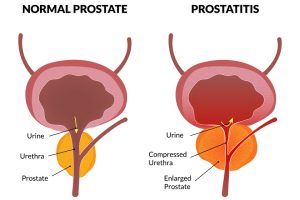 5 Common Prostate Problems And How Assisted Living In South Valley, NM Can Help