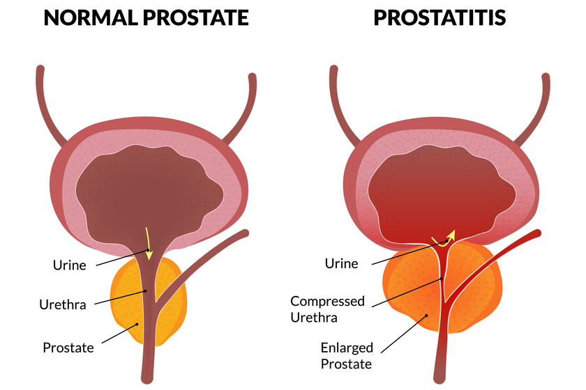 5 Common Prostate Problems And How Assisted Living In South Valley, NM ...