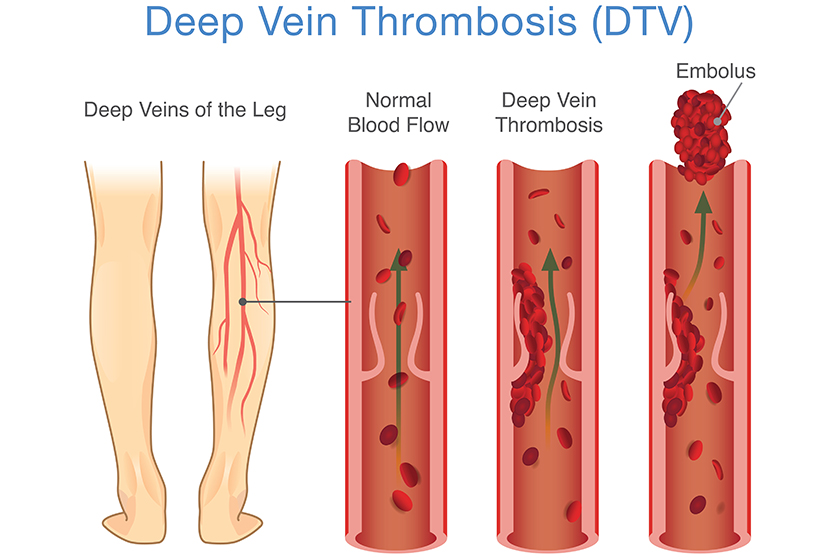 Medical Diagram of Deep Vein Thrombosis