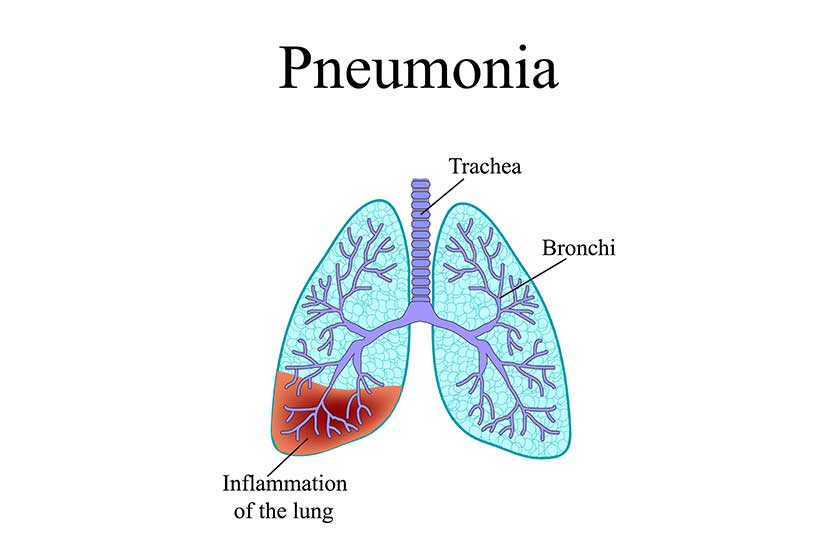 Pneumonia the anatomical structure of the human lung vector illustration on isolated background Pneumonia the anatomical structure of the human lung vector illustration on isolated background