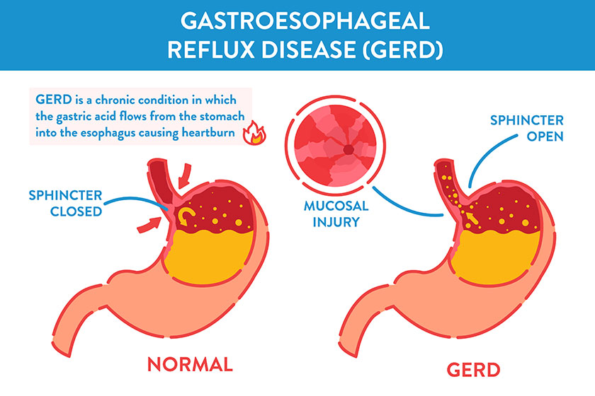 Gerd stomach acid reflux disease infographic medical poster
