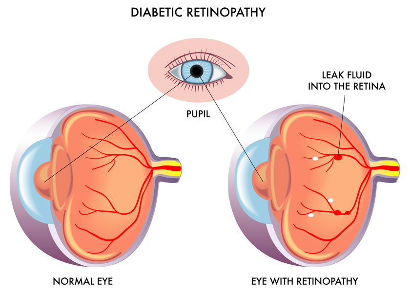 diabetic retinopathy in seniors a closer look at the symptoms img