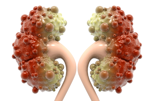 kidney disease white background