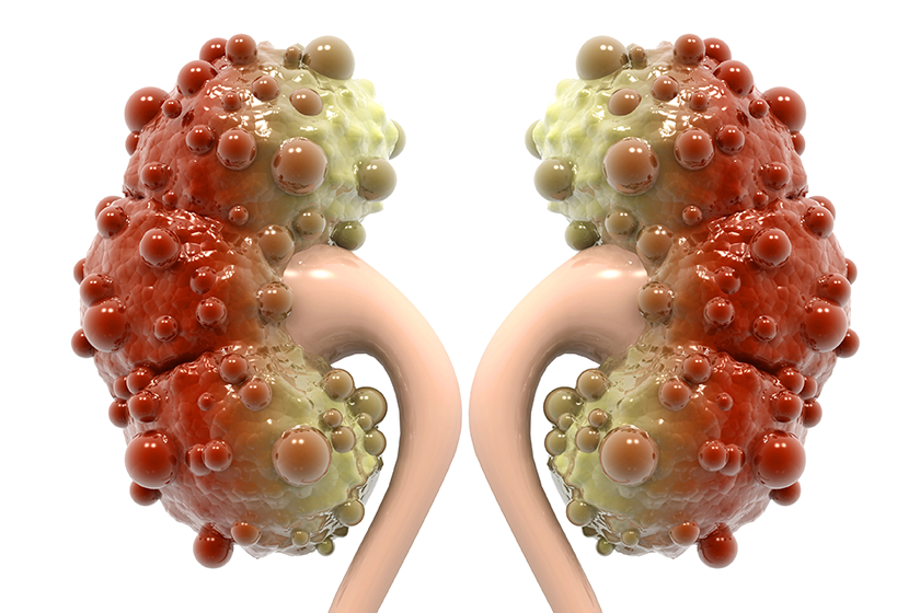 kidney disease white background kidney disease white background