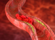 atherosclerosis is an accumulation of cholesterol