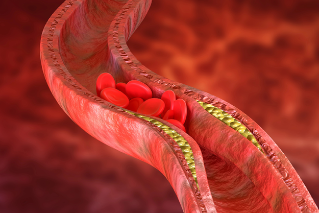 atherosclerosis is an accumulation of cholesterol