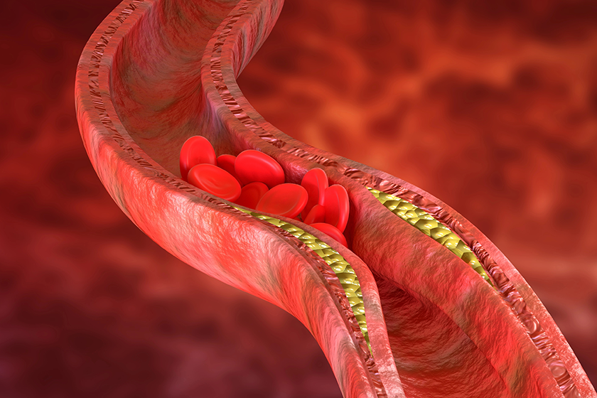 atherosclerosis is an accumulation of cholesterol