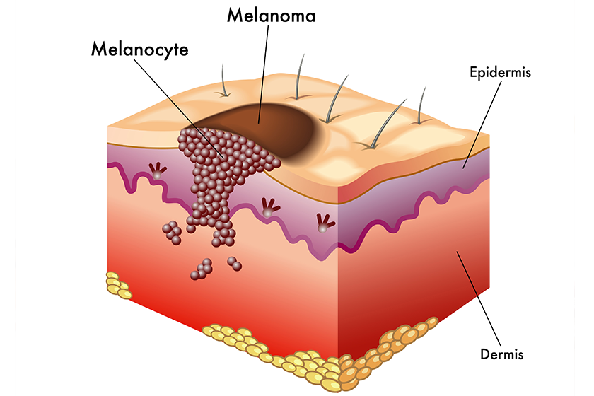 colorful melanoma scheme